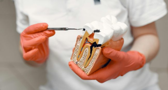 Root Canal